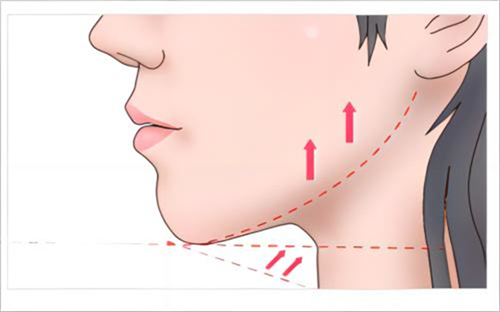 下巴提升术后示例图