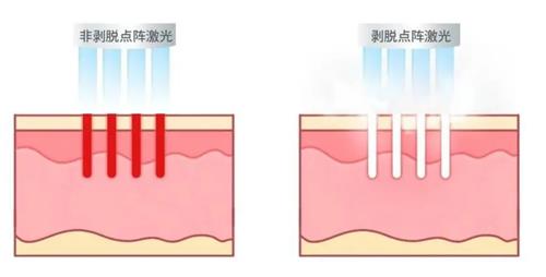 不同类型的点阵激光 不同类型的点阵激光