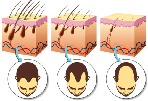 不同程度脱发的对比图解