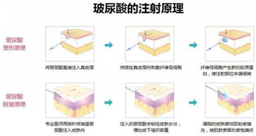 玻尿酸注射原理 玻尿酸注射原理