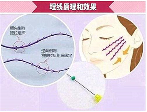 埋线原理与成效动画演示图