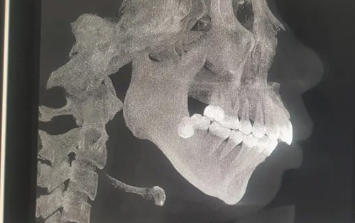 需要做正颌手术的骨骼图 需要做正颌手术的骨骼图
