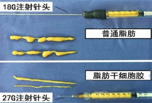 自体脂肪填充需要的脂肪提纯后的样子图片 自体脂肪填充需要的脂肪提纯后的样子图片