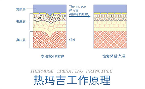 热玛吉工作示意图 热玛吉工作示意图