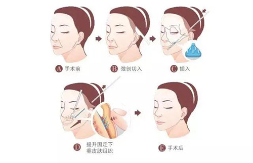 韩国医美便宜项目大揭秘：如何在预算内选择更适合自己的美容疗程？
