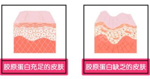 胶原蛋白填充的皮肤对比 胶原蛋白填充的皮肤对比