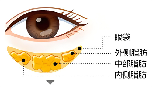 怀化做去眼袋要多少钱？内切祛眼袋4000+外切祛眼袋5000+二次去眼袋8000+