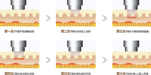 黄金微针 黄金微针