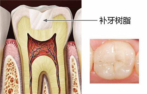 补牙树脂结果图