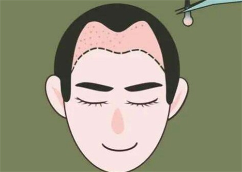 M型发际线种植 M型发际线种植