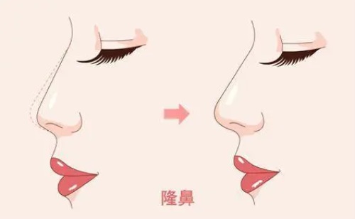隆鼻对比图 隆鼻对比图
