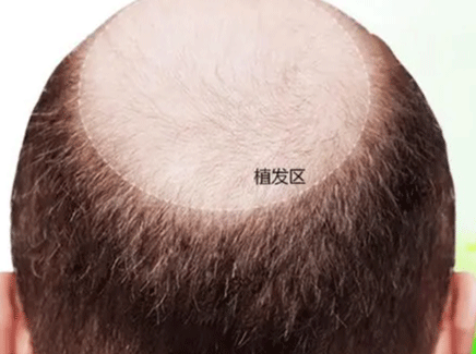 脱发表现图 脱发表现图