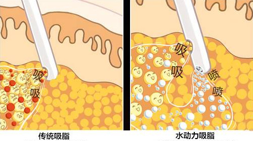 杭州上颜医疗美容收费价格表新版发布：双眼皮|单部位吸脂2980+私密整形1980+植发6800+