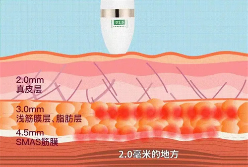 超声炮层次