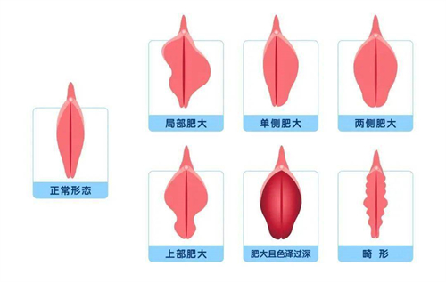 正常阴唇形态和阴唇肥大对比动画图 正常阴唇形态和阴唇肥大对比动画图