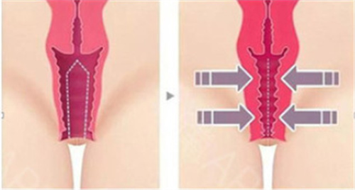 私密紧缩手术前后对比差异