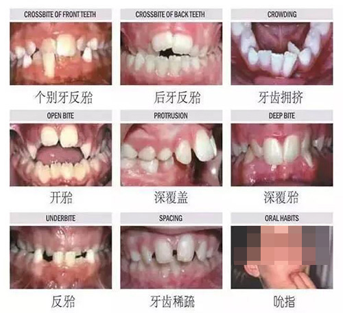 40岁了，牙齿矫正是否还来得及？听听医师怎么说，或许能改变你对牙齿健康的看法！