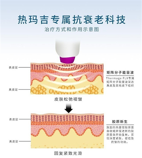 面部除皱热玛吉方式演示图 面部除皱热玛吉方式演示图
