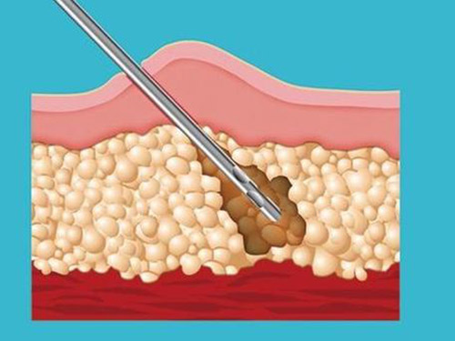 吸脂针图片