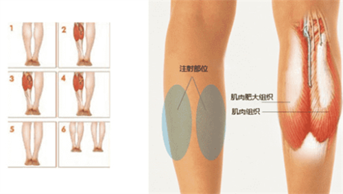 瘦腿注射点位图
