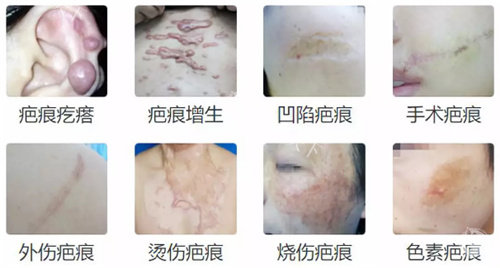 不同疤痕的类型 不同疤痕的类型