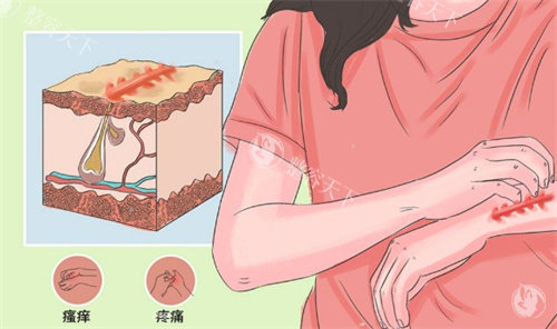 疤痕疙瘩的样子 疤痕疙瘩的样子