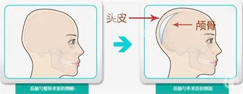 后脑勺手术 后脑勺手术