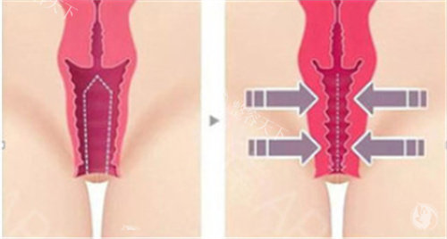 私密紧缩手术前后对比差异