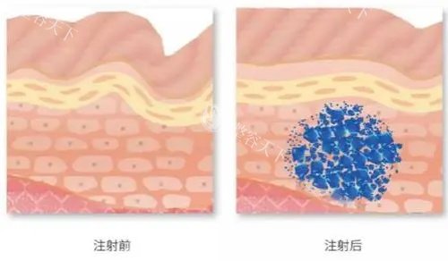 打破谣言!优妮金玻尿酸作为中高端国产玻尿酸,填充后稳定不易移位,也不是杂牌子哦!