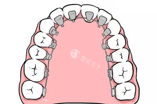 你知道吗？地包天牙齿矫正其实没有年龄限制，适合不同年龄段的矫正方法大揭秘！