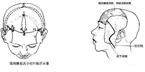面部小切口悬吊术 面部小切口悬吊术