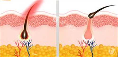 脱毛前后毛囊的变化