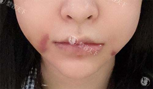 轮廓手术面部肿胀 轮廓手术面部肿胀