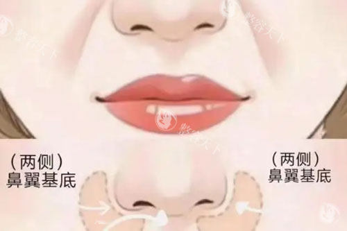 鼻翼、鼻基底卡通图 鼻翼、鼻基底卡通图