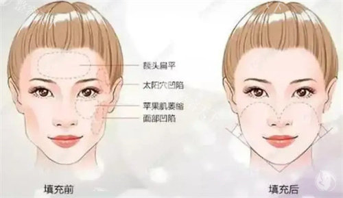 面颊填充术前后对比 面颊填充术前后对比