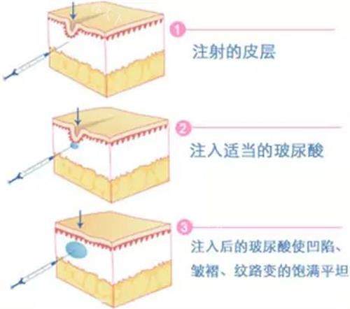 玻尿酸注射示意图 玻尿酸注射示意图