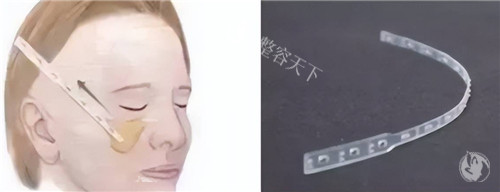微拉美提升示意图 微拉美提升示意图