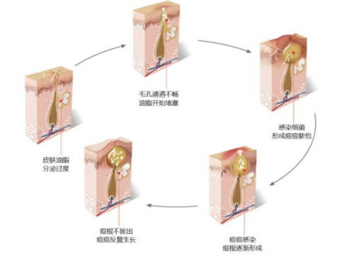 痘坑怎么生成的 痘坑怎么生成的