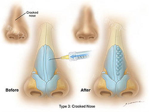 玻尿酸注射隆鼻前后对比