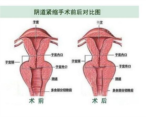 阴道紧缩手术前后对比图