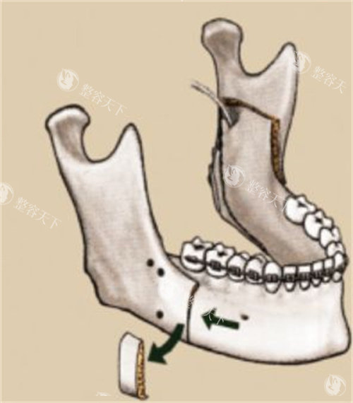 下颌垂直截骨术演示动画图