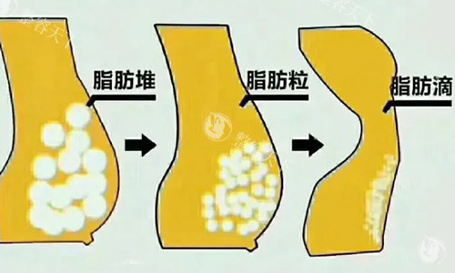 脂肪型胸部脂肪展示 脂肪型胸部脂肪展示