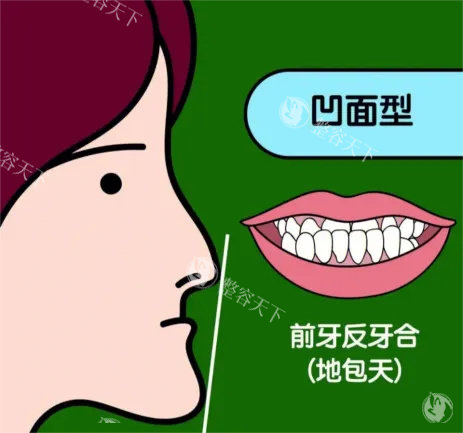 地包天漫画示意图 地包天漫画示意图