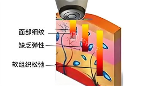 热拉提作用 热拉提作用