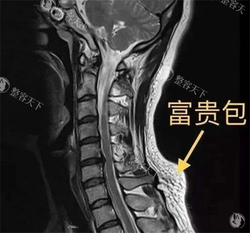 关于黄学峰富贵包原诗璐整形富贵包项目价格及医生介绍，让您在选择整形时更加心中有数！