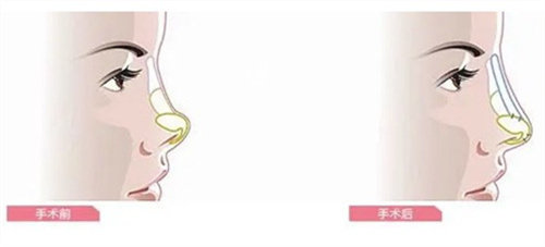 隆鼻手术前后对比 隆鼻手术前后对比