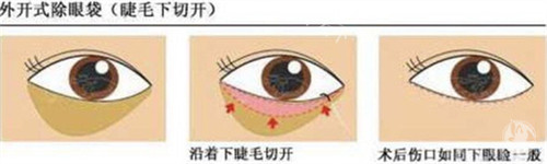 外切法祛眼袋手术步骤