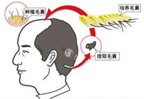 植发提取毛囊示意图 植发提取毛囊示意图