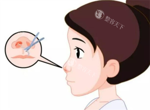 李信锋做鼻子多少钱?单部位1万+|鼻综合4w+|鼻修复7w+详细价格这里都有