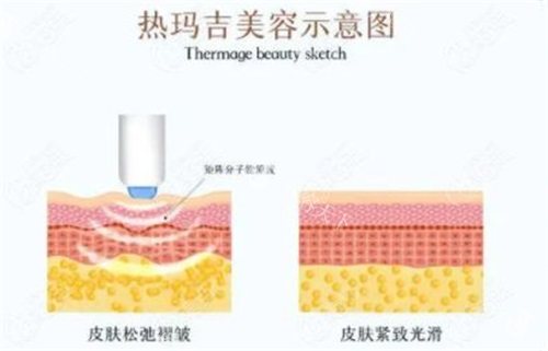 热玛吉三个月后对比照!通过这份对比照记录肌肤变化全过程